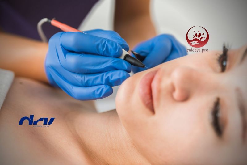 Electrodepilación Corporal